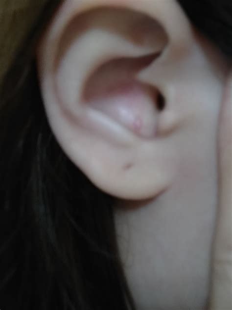 How Do I Determine If The White Bump In My Ear Is A Mere Pimple Or A