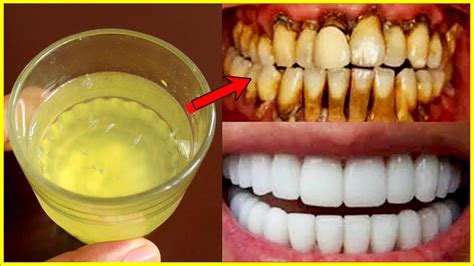 Get Rid Of Yellow Teeth Fast Naturally In 2 Minutes Magical Remedy