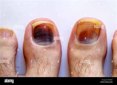 Bruises On The Feet Hi Res Stock Photography And Images Alamy
