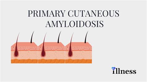 Primary Cutaneous Amyloidosis Overview Causes Symptoms Treatment