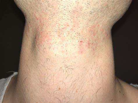 After I Shave My Beard My Neck Gets Tons Of Red Bumps How Can I Avoid