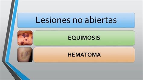 Diferencia Entre Equimosis Y Hematoma
