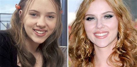 Scarlett Johansson Plastic Surgery Before And After