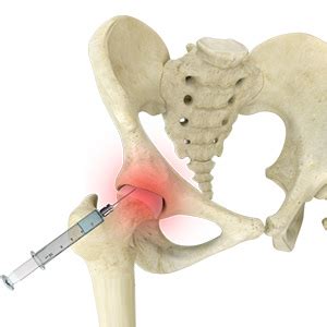 Interventional therapy for hip pain includes cortisone injection, nerve ablation and placement of spinal cord stimulator or intrathecal catheter to deliver opioid medications in cerebrospinal fluid. Joint Injections (hip/knee/shoulder,wrist) Pain Treatment ...