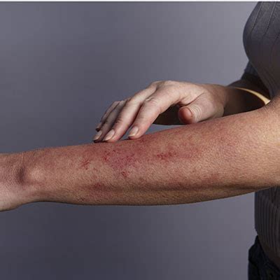 Common Skin Rashes On Arms Pictures Photos Rezfoods Resep Masakan