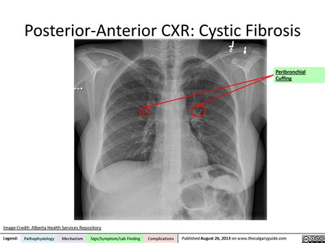 Cystic Fibrosis Posterior Anterior Chest X Ray Calgary Guide