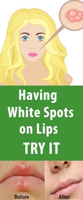 Home Remedies To Get Rid Of White Bumps On Lips Top 5 Diy