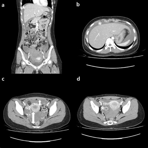 Abdomen Pelvic Ct A In Coronal View There Is A Liver Dome Fluid
