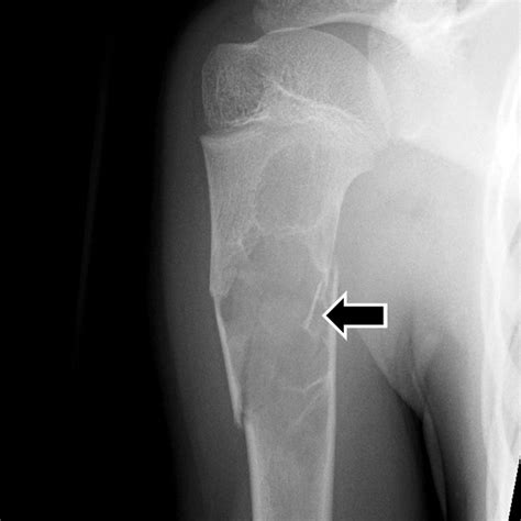Unicameral Bone Cyst With Fracture And Fallen Fragment Sign Radiology
