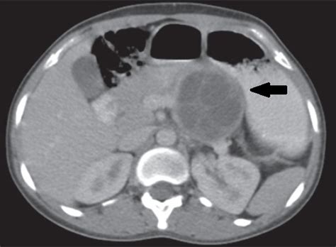 Cureus Abdominal Hydatidosis Unusual And Usual Locations In A North