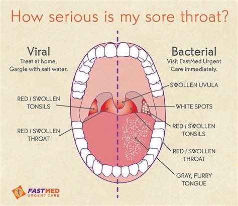 Get Inspired For What Throat Looks Like With Strep