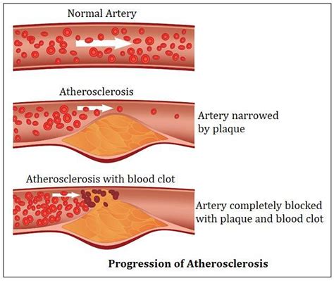 Q What Is The Difference Between Atherosclerosis And Arteriosclerosis