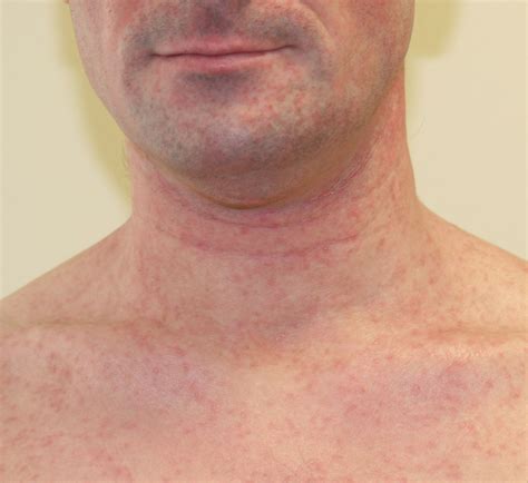 A Skin Rash To Remember The Bmj