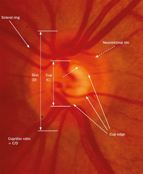 Community Eye Health Journal The Optic Nerve Head In Glaucoma