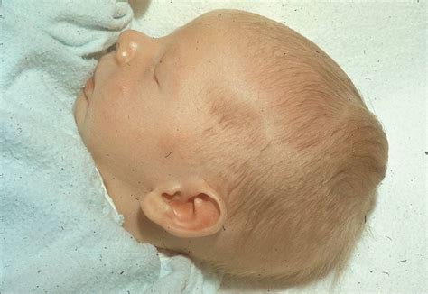 Infant Cephalohematoma Causes Treatment And Preventio