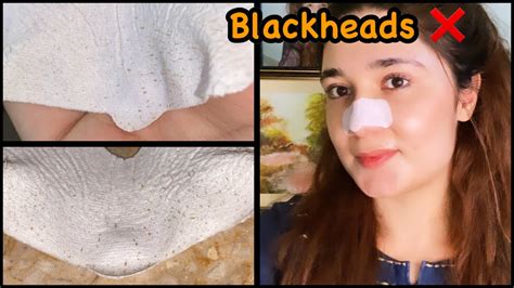 Best Way To Remove “ Blackheads “ Youtube