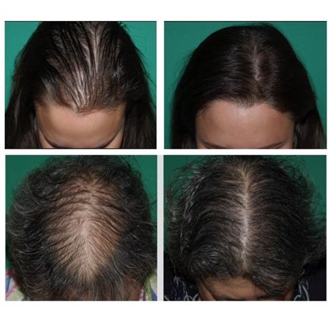 Female Hair Loss Causes And Treatment Options Beauty Refined