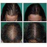 Photos of Hair Loss Treatment Chicago