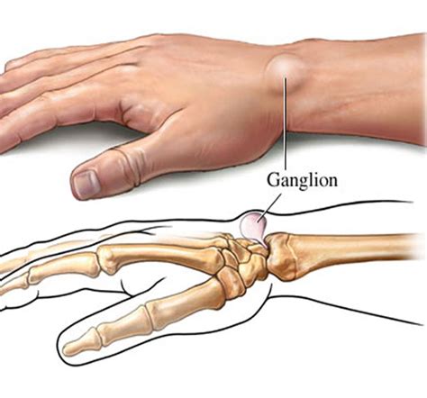 Do Ganglion Cysts Appear Suddenly Duane Pickrell Kapsels