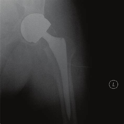 Anteroposterior Radiograph Of The Hip At Presentation Download High