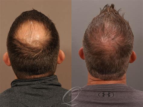 Male Fue Hair Transplant Before And After Photos Patient 1001537