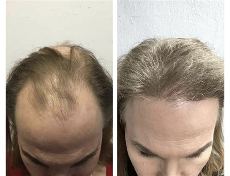 Mens Hair Transplant Cost And Results Hairline Transplant Before
