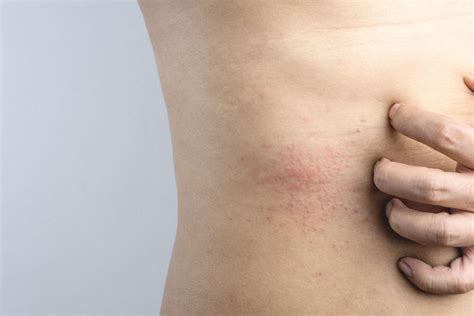Eczema On Stomach Causes Symptoms And Treatment