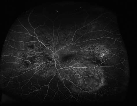 Choroidal Metastasis Retina Image Bank