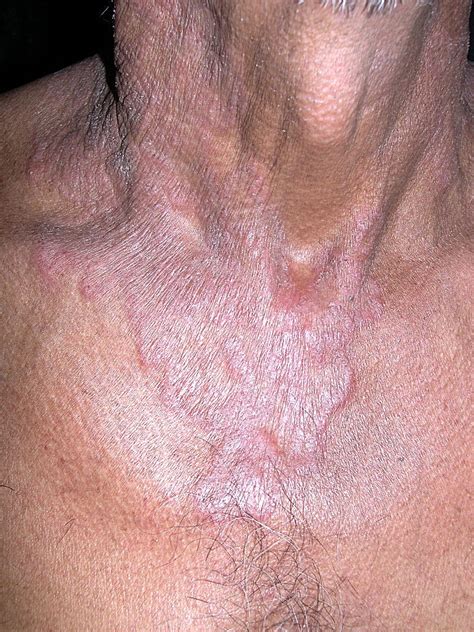 Tinea Corporis Images Pictures Photos