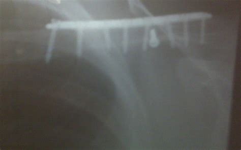 Collarbone Surgery Bones Displacing After Surgery Health And Fitness