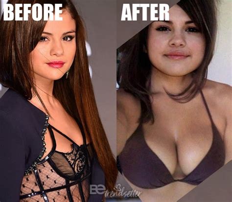 Selena Gomez Breast Implants Photos Before After Surgery Hot Sex Picture