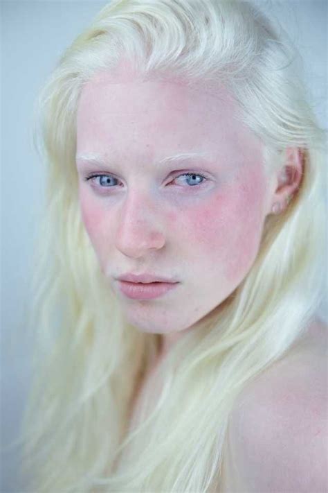 I Took A Picture Of A Beautiful Girl With Albinism Imgur Pretty