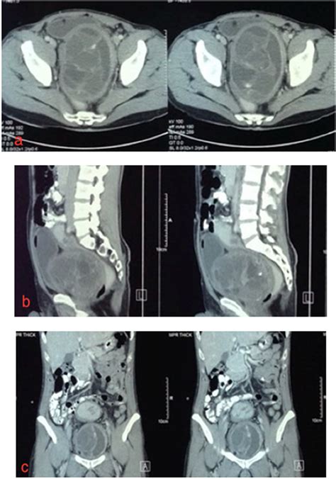 Figure 2 Abdominal Contrast Enhanced Computed Tomography Ct Scan A