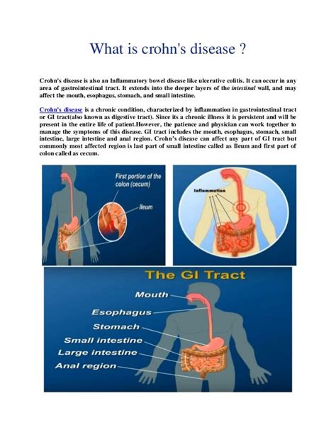Crohn S Disease Causes Symptoms And Treatment