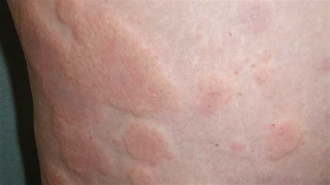 Ada banyak jenis alergi kulit, mulai dari dermatitis atopik hingga angioedema. Macam Macam Alergi Kulit Dan Gambarnya - Mutakhir