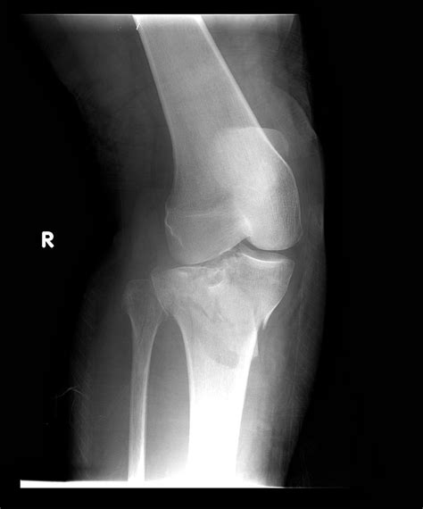 Tibial Plateau Fracture Broken Top Of Shin Bone