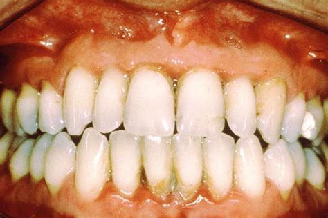 Gum Infection Causes Symptoms Treatment Pictures Healthmd