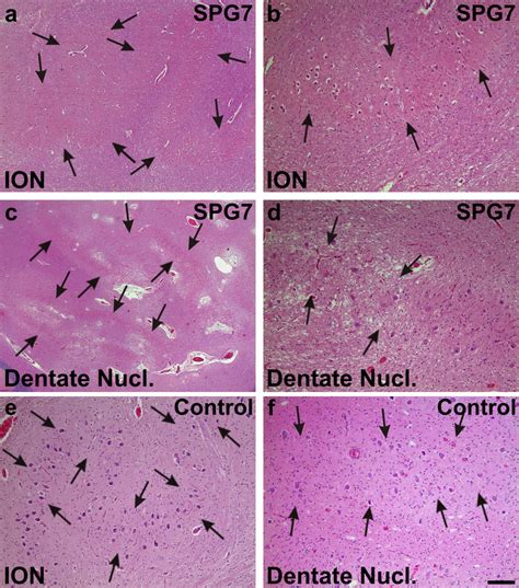 Moderate Neuron Loss And Gliosis In The Inferior Olivary Nucleus Ion