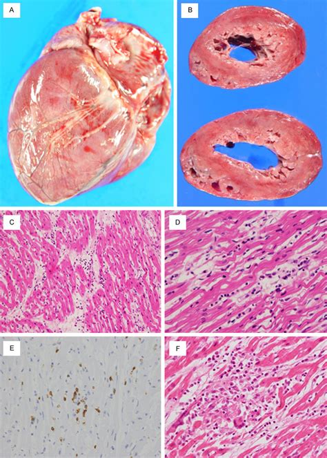 Macroscopic And Histological Findings In The Heart A B Macroscopic