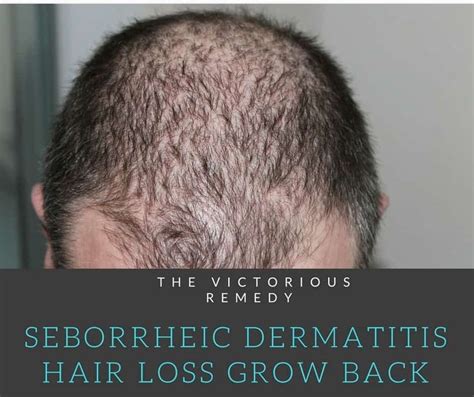 Seborrheic Dermatitis Hair Loss Grow Back The Victorious Remedy Hair Loss Remedies Hair