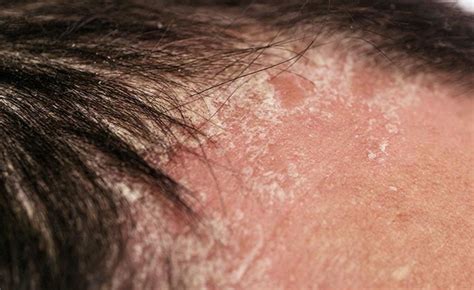 Psoriasis On The Face Symptoms What It Looks Like And Treatment