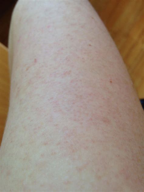 Getting Rid Of Keratosis Pilaris Aka Chicken Skin Asianbeauty