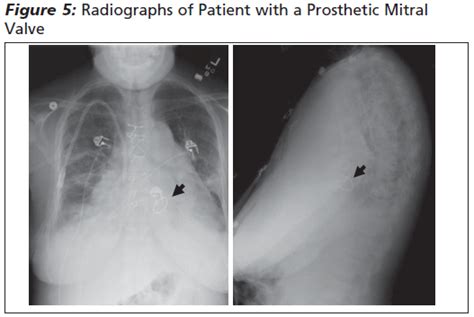 Complications Of Prosthetic Heart Valves In The Emergency Department