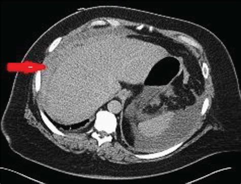 A Axial Postcontrast Ct Image Demonstrating Acute Subcapsular