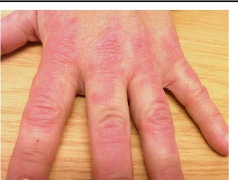 Fig 2 A Photograph Showing The Left Hand Of The Patient With A Rash