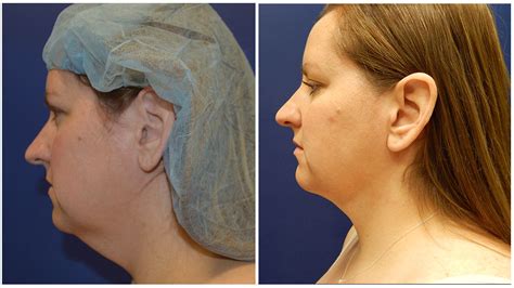 Double Chin Liposuction Surgery Milwaukee