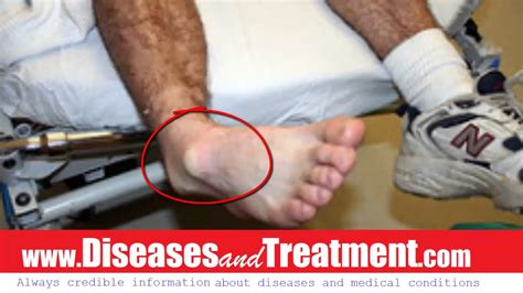 Dislocated Ankle Causes Diagnosis Symptoms Treatment Prognosis