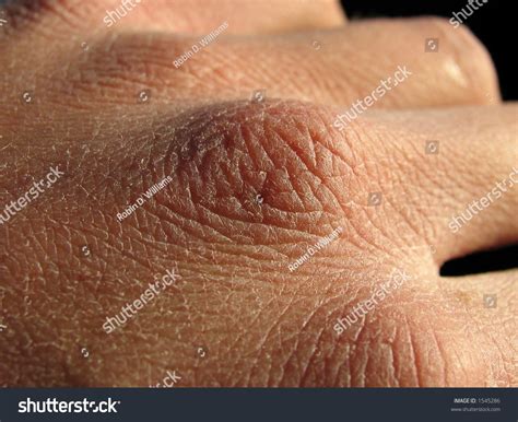 Close Hand Very Dry Skin Deep Stock Photo 1545286 Shutterstock