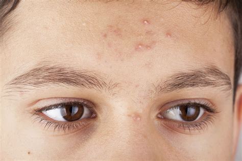 acne pustule types causes and treatments