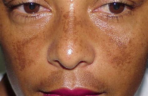 Best Skin Lightening To Eliminate Hyperpigmentation Or Melasma How To